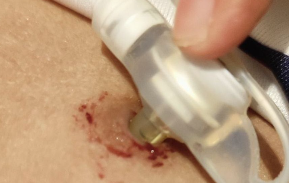 NSPA ah feeding tube eh nuhoadhi 6 aharu ge kujjaku maruvi massala balanee