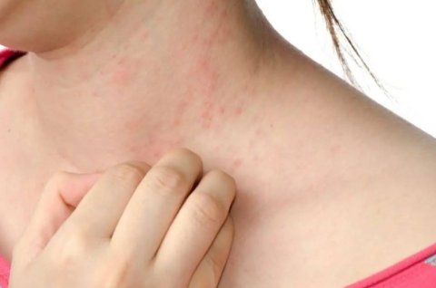 Eczema: aanmu vamun anna mi bayya beheygothun engenee kihaa varakah?